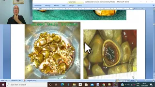 Biliary  disorders in Arabic 1 ( Types of Gall Bladder Stones ) , by Dr. Wahdan