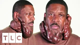 Chronic Keloids Are Seriously Impacting This Man's Life | Body Bizarre