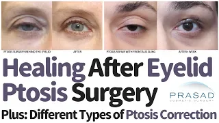 Different Types of Eyelid Ptosis, Surgical Correction Techniques, and Expected Healing Time