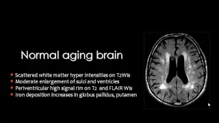 Imaging of White matter II   Prof Dr  Mamdouh Mahfouz In Arabic 720p