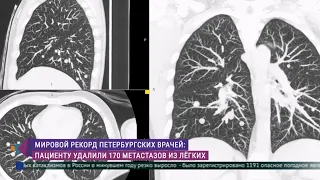 Мировой рекорд петербургских врачей! Пациенту удалили 170 метастазов из лёгких