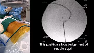 PCNL Bullseye Prone Puncture