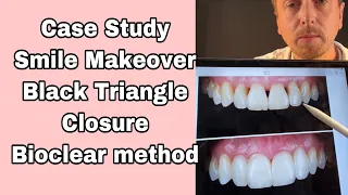 Black Triangles fixed with Bioclear Method - Smile Makeover