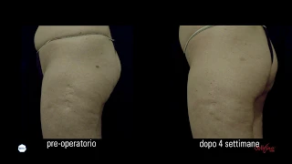 Cellfina - Trattamento estetico anti cellulite non invasivo