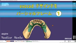 exocad  partial denture design training  パーシャルデンチャートレーニング