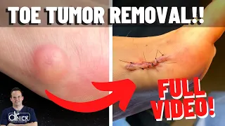 Surgical Removal of Toe Tumor: Watch How It's Done"