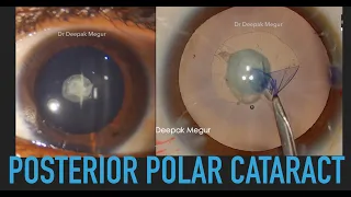 Posterior Polar Cataract - Dr Deepak Megur