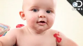 Why Do We Have Birthmarks?