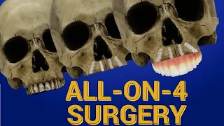 ALL on 4  Dental Implant Surgery: Step-by-Step Guide