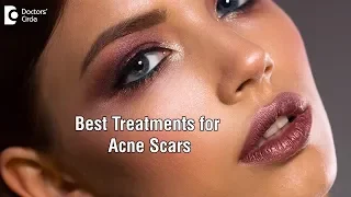 Success for treating acne scars stage ll with peels, skin needling or laser-Dr. Aruna Prasad