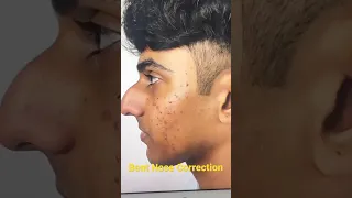 Amazing Nose Correction Plastic Surgery by Dr sunil richardson - Before and After 2 months