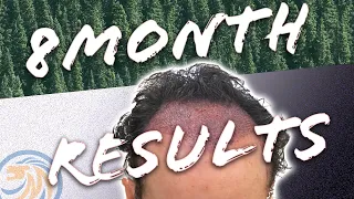 Clark Kent Follow-up - 8 Month Hair Transplant Results
