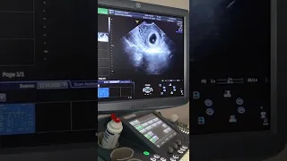 First pregnancy ultrasound at 6w4d, heartbeat