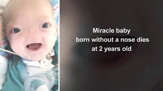 Pathetic  'Miracle baby' born without a nose dies at 2 years old