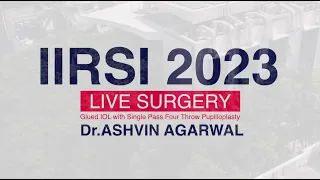 Dr.Ashvin Agarwal - Glued IOL with Single Pass Four Throw Pupilloplasty - IIRSI 2023 Live Surgery