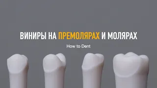 Виниры на премолярах и молярах. VeneerLay