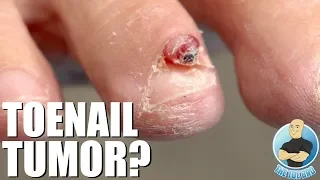 REMOVING A HUGE TOENAIL TUMOR GROWTH