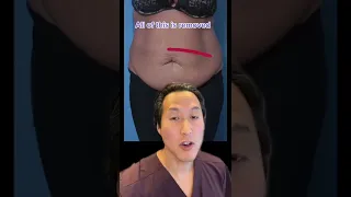 Watch This Tummy Transformation! #shorts #tummytuck