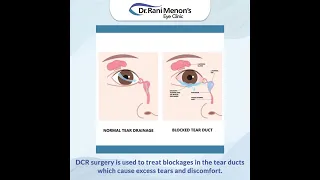 What is DCR or DacryoCystoRhinostomy?
