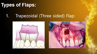 Basic Principles of Oral Surgery part 3 and 4/ Dr. Noor Sahban / Fourth Grade