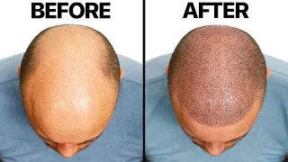 Surgeon Reacts to A Bald Man Gets A Hair Transplant | BuzzFeed