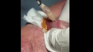 Huge botfly larvae removed from his lips