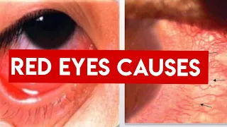 RED EYE || CAUSES || Conjunctivitis Vs Uveitis vs Acute angle closure Glaucoma