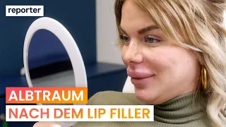 Hyaluron auflösen: Sie will ihren Lip-Filler-Fail loswerden | reporter