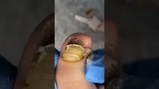 Removing a old and dry fungal toenail with onychomycosis 👣 #satisfying