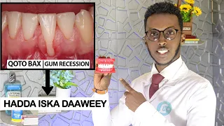 SIDA UGU FUDUD EE LOO DAAWEEYO CIRIDKA QODMO | GUM RECESSION