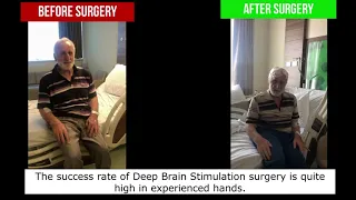 Deep Brain Stimulation surgery is a very effective treatment method in Parkinson's disease.