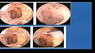 Presentation on Endoscopic Optic Nerve Decompression