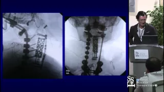 Spinal Tumors: Surgical Management & Complication Avoidance by Ehud Mendel, M.D.