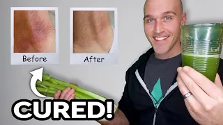 How To Cure Eczema: CELERY JUICE (It Works!)