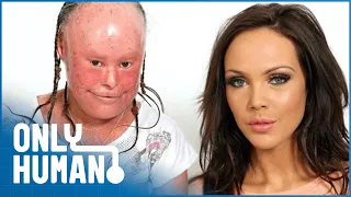 A Glamour Model & A Woman With Facial Disfigurements Meet: The Ugly Face of Prejudice | Only Human