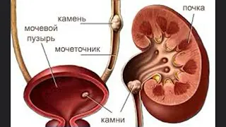 Психосоматика камней в почках