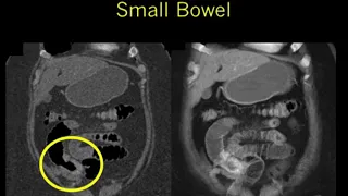 CT Evaluation of Small Bowel Obstruction Part 2