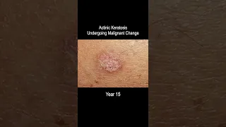 Skin Cancer Development Time Lapse (Normal to Squamous Cell Carcinoma Over 25 Years)