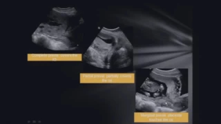 Imaging of Abnormal Placentation