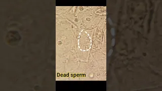 dead sperm in urine R E under microscope #viralvideo #science #medical  #doctor #viralyoutubevideo