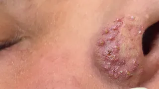 Suri Job 675: Awesome Blackheads Extraction