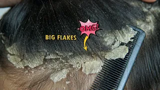 Dandruff Scratching Big Flakes Short Hair #1257
