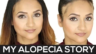 My Alopecia Story | Alopecia Areata