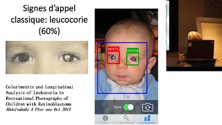 Optimisation du traitement des Rétinoblastomes