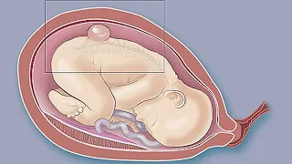 Surgery Plus Stem Cells Before Birth Could Improve Outcomes with Spina Bifida