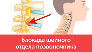 Блокада шейного отдела позвоночника