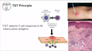 Tuberculosis: Diagnosis