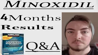 Minoxidil (rogaine) Beard, Does it Work? Results + Q&A