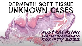 Dermpath Soft Tissue Unknowns - 12 Cases for Australasian Dermatopathology Society 2022 meeting