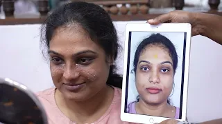 Best Female Rhinoplasty Nose Surgery India - Pre Surgery to Recovery